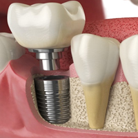 ایمپلنت در مطب دکتر فتح اله عباسپور